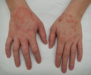 Spongiotic Dermatitis